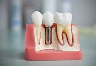 Имплантация зубов в Туле