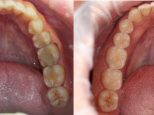 Керамические реставрации жевательной группы зубов. Слева до установки(на зубах несостоятельные композитные реставрации(пломбы) справа после установки керамических реставраций