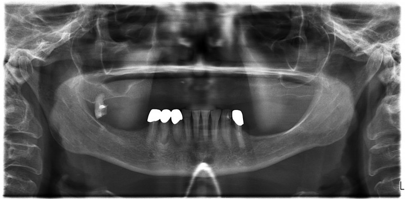 снимок до имплантации зубов