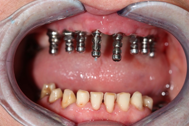 фото процесса имплантации зубов