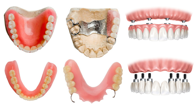 Виды современных зубных протезов